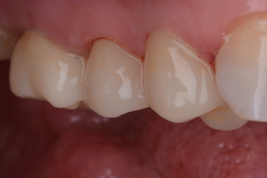 بعد تركيبات اسنان